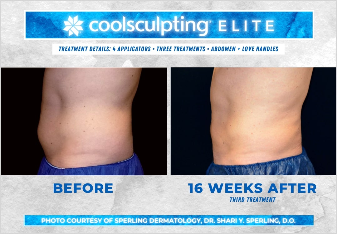 CoolSculpting  Know your applicators before getting treated