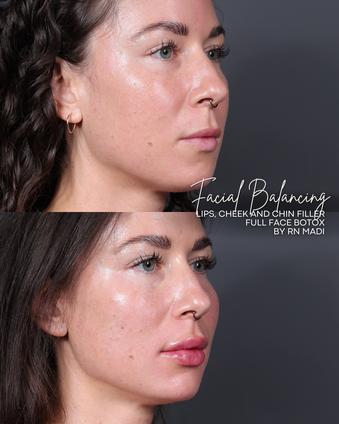 ANNIVERSARY SPECIAL: $150 off of Dermal Filler with Injector Madi