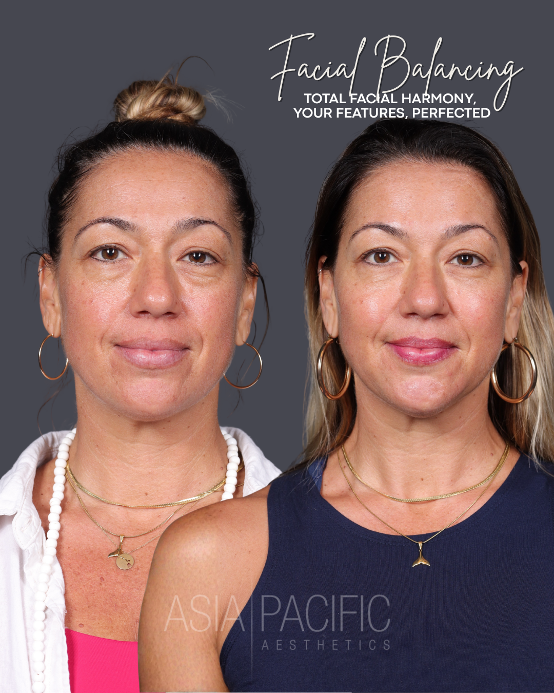 ANNIVERSARY SPECIAL: $150 off of Dermal Filler with Injector Madi