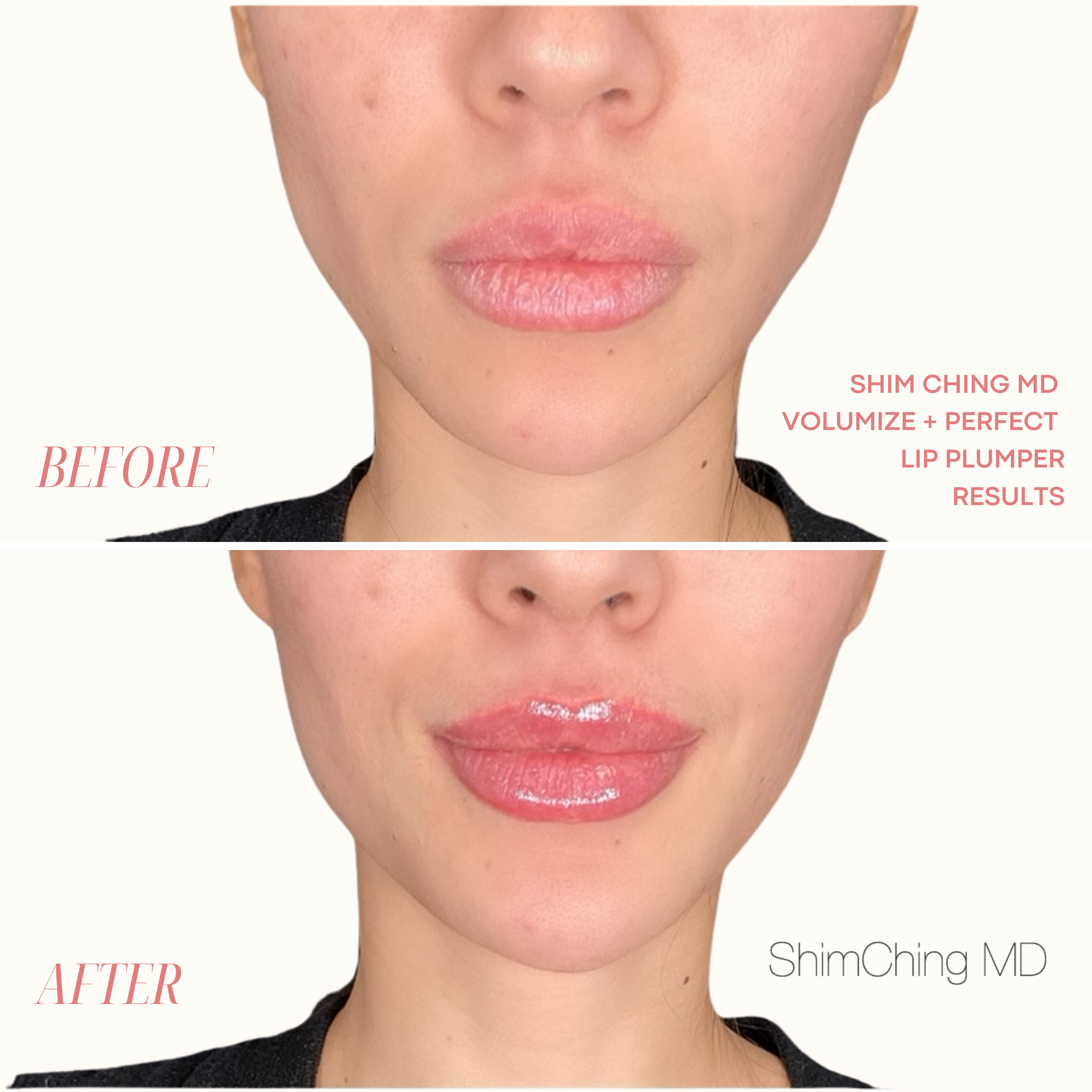 Shim Ching MD Lip Plumper - 25% OFF Intro Special