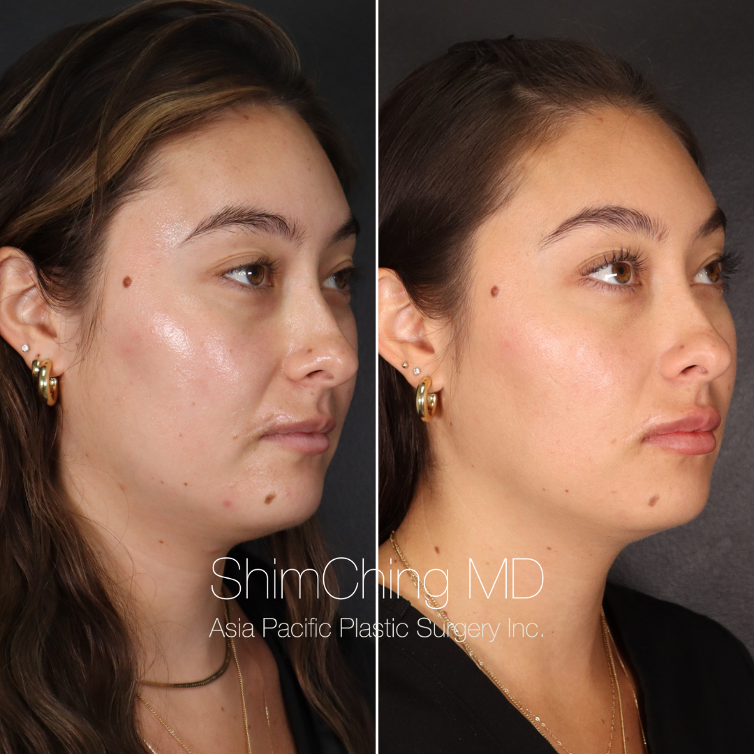 RevLite Laser Full Face 6 Treatments Asia Pacific Plastic