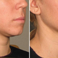 Ultherapy Treatment - Full Face & Neck - Before and After