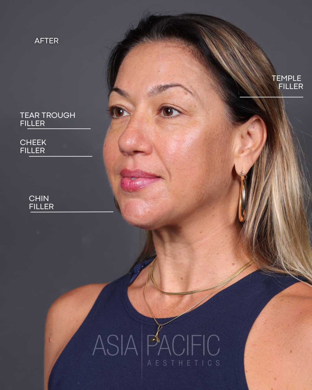 ANNIVERSARY SPECIAL: $150 off of Dermal Filler with Injector Madi