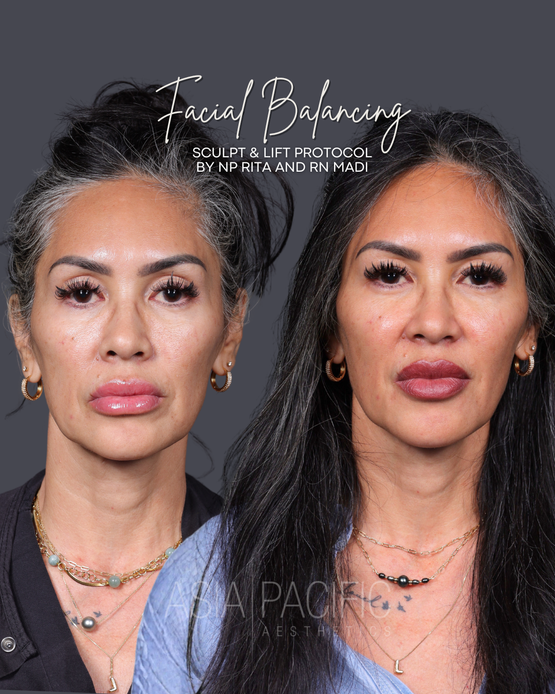ANNIVERSARY SPECIAL: $150 off of Dermal Filler with Injector Madi