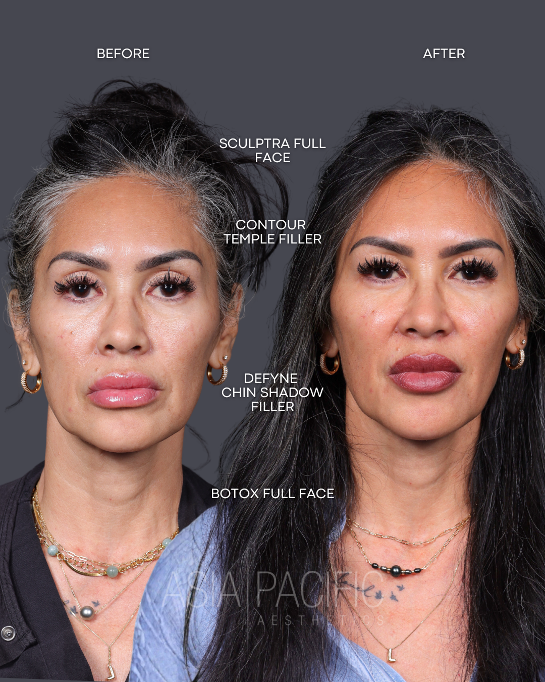ANNIVERSARY SPECIAL: $150 off of Dermal Filler with Injector Madi