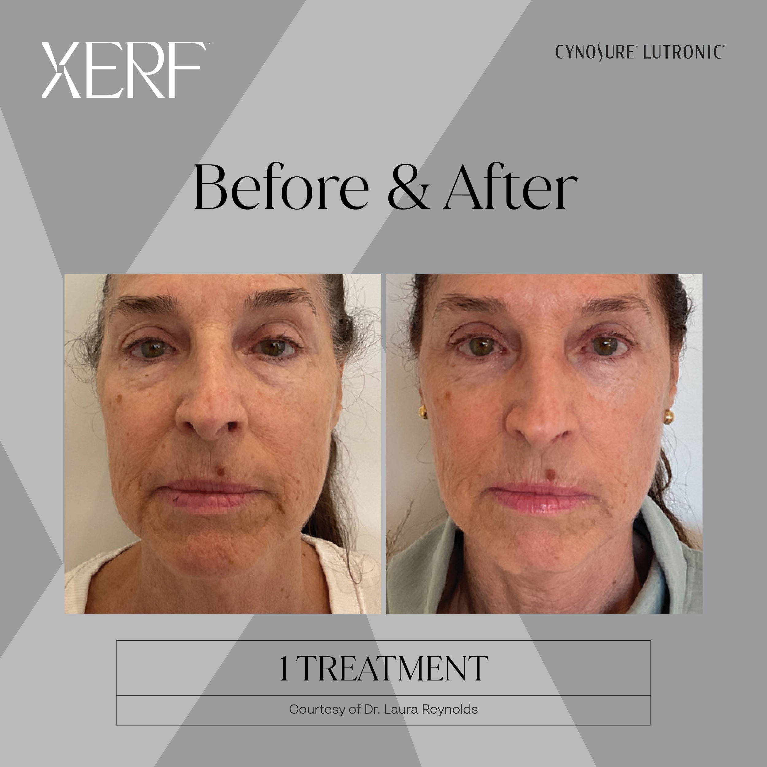 XERF (SPECIAL INTRO PRICING) Single Treatment