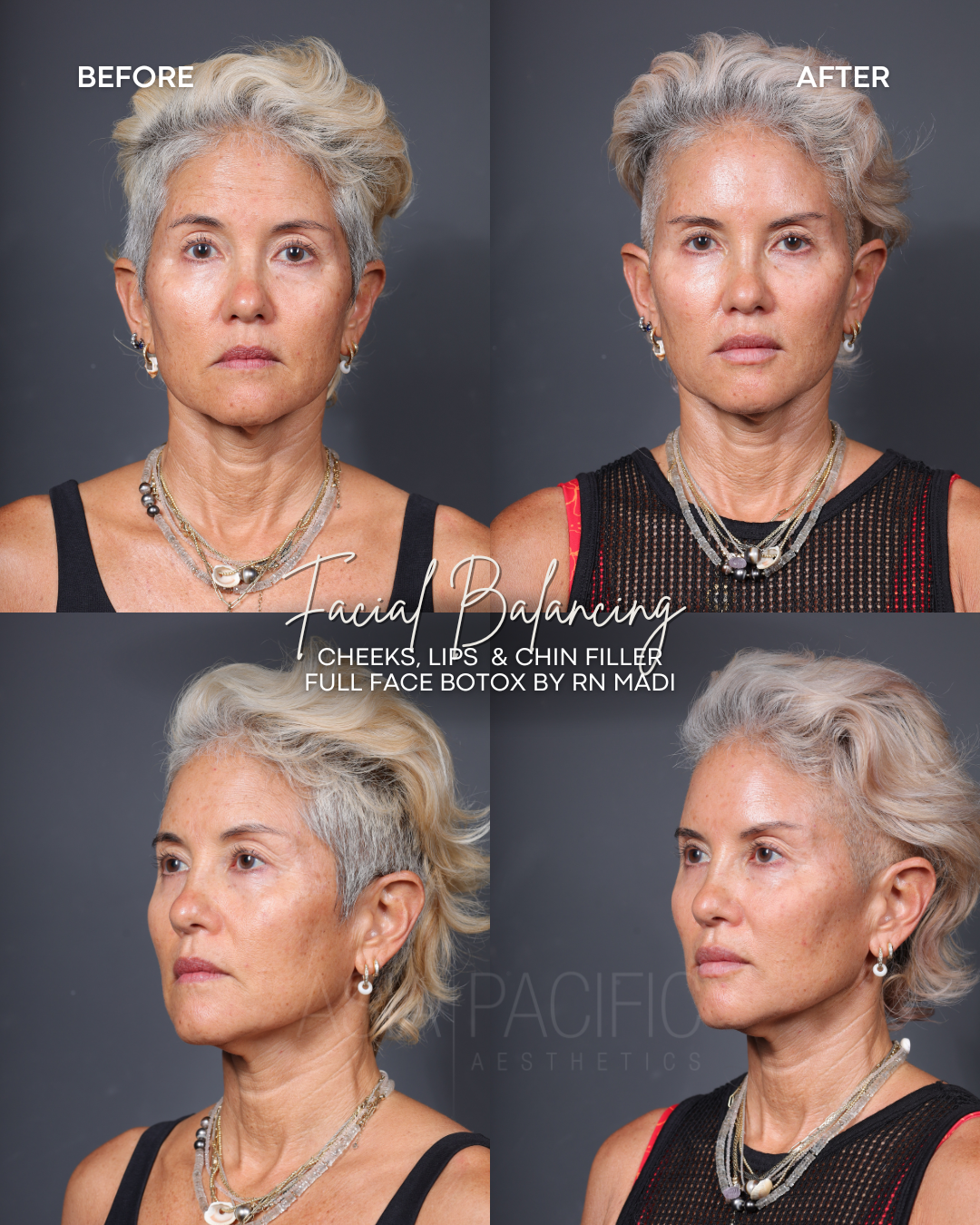 ANNIVERSARY SPECIAL: $150 off of Dermal Filler with Injector Madi