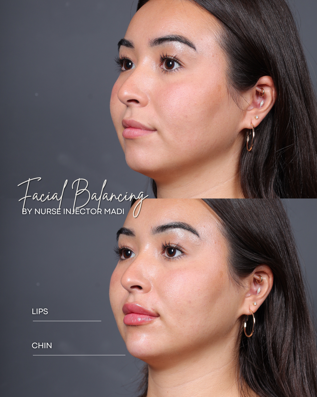 ANNIVERSARY SPECIAL: $150 off of Dermal Filler with Injector Madi