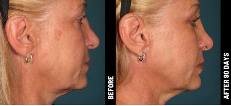 Ultherapy Treatment - Full Face & Neck