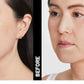 Ultherapy Treatment - Upper Face