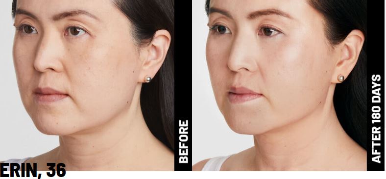 Ultherapy Treatment - Upper Face