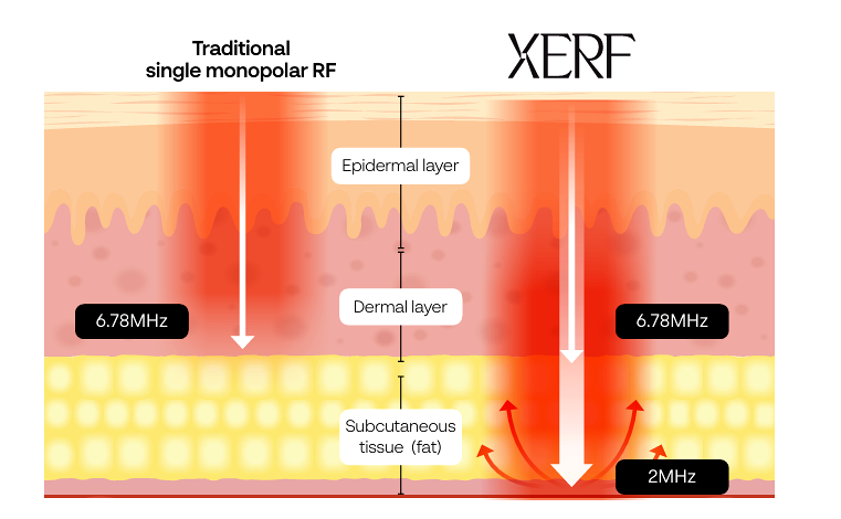 XERF (SPECIAL INTRO PRICING) Single Treatment