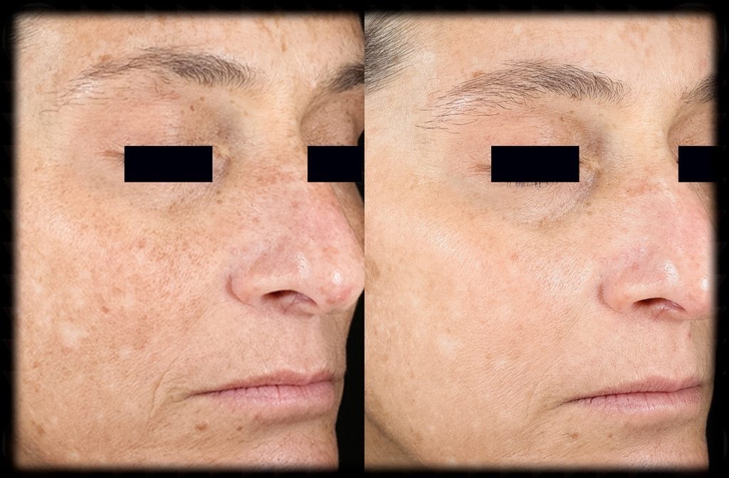 PicoSure Focus Laser - Full Face - 6 Treatments