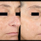 PicoSure Focus Laser - Full Face - 6 Treatments