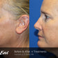 Tempsure - Full Face - 6 Treatments