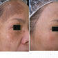 RevLite Laser - Full Face - 6 Treatments