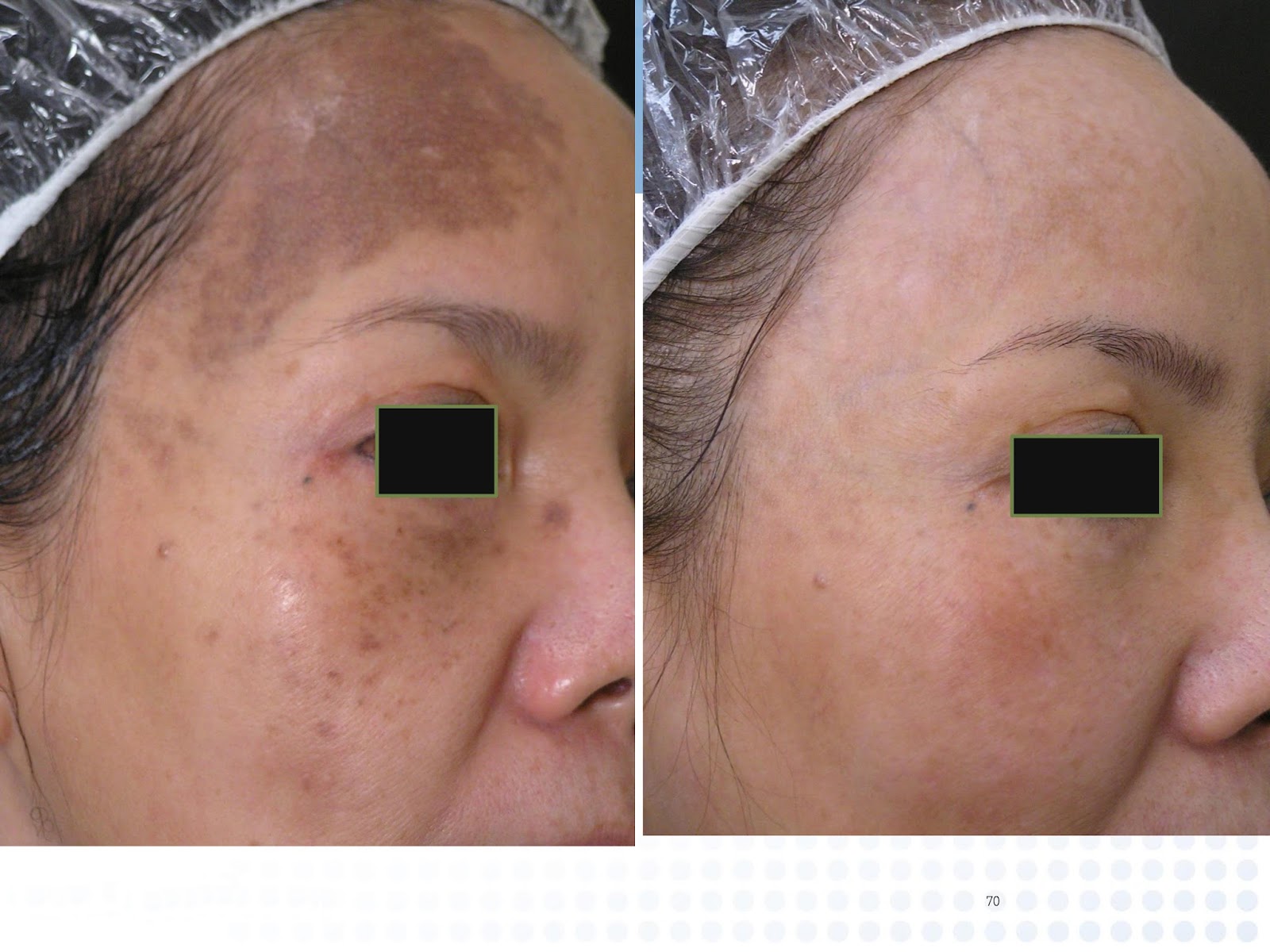RevLite Laser - Full Face - 6 Treatments