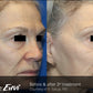 Tempsure - Full Face - 1 Treatment