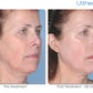 Ultherapy Treatment - Full Face - Before and After