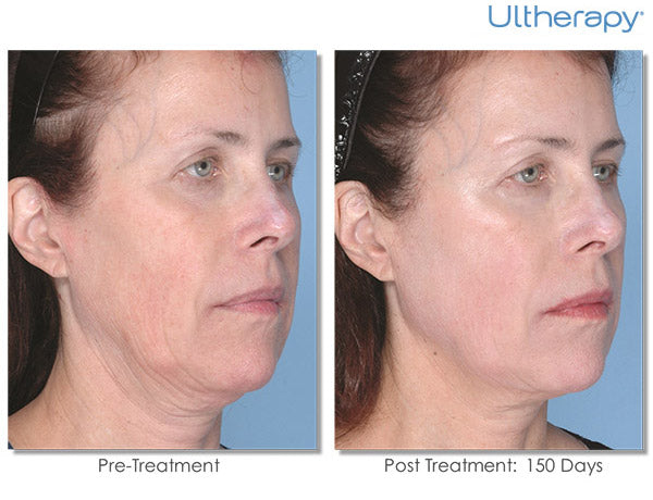 Ultherapy Treatment - Full Face & Neck - Before and After