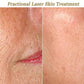 1540 Fractional Non-Ablative Laser - Full Face - 6 Treatments
