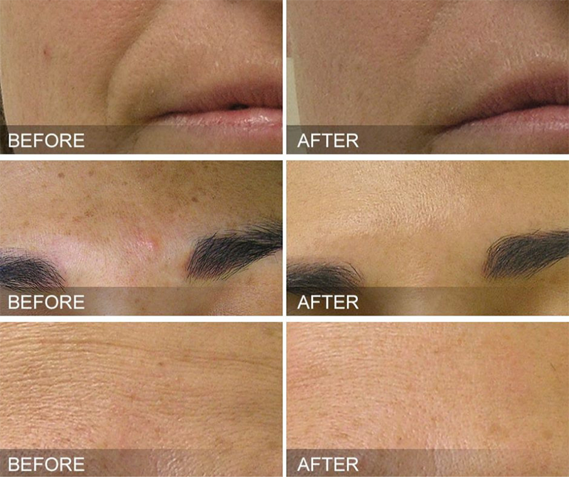 Premium Hydrafacial - Before and After