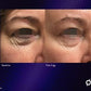 Opus Plasma Laser - Full Face - 3 Treatments