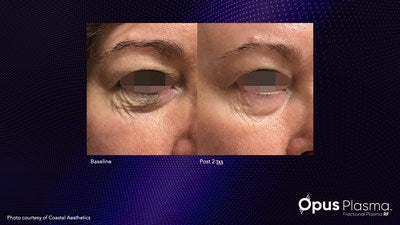 Opus Plasma Laser - Half Face - 3 Treatments
