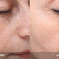 PicoSure Focus Laser - Full Face - 3 Treatments